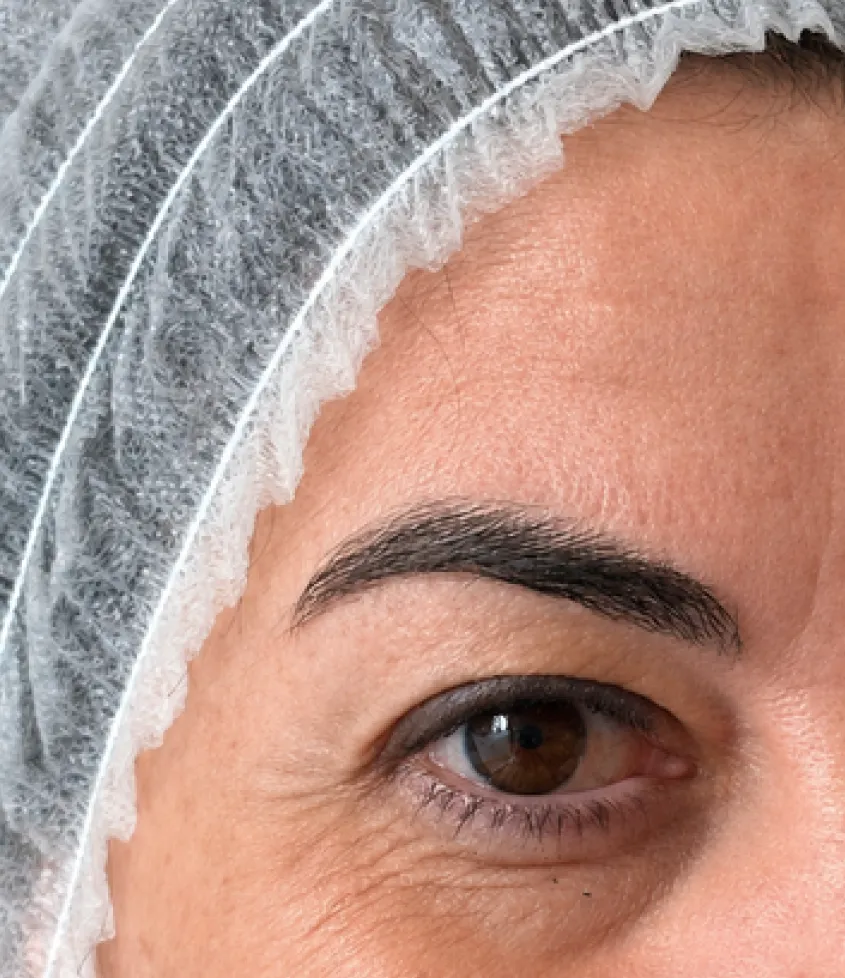 Região periocular antes da toxina botulínica, com linhas finas à volta do olho