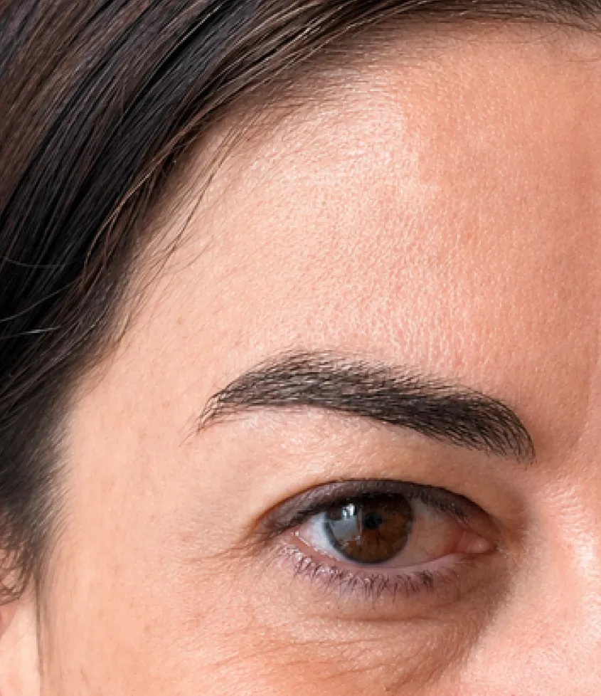 Região periocular depois da toxina botulínica, com as rugas de expressão suavizadas