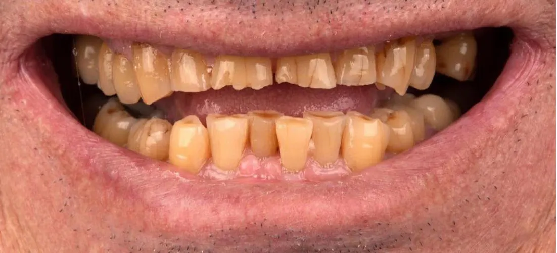 Sorriso de um homem antes do tratamento, com os dentes muito gastos, lascados e amarelados