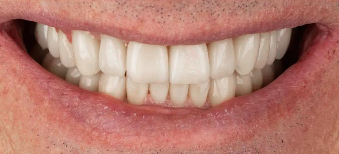 O mesmo sorriso depois do tratamento, com os dentes de cima e de baixo brancos, inteiros e alinhados