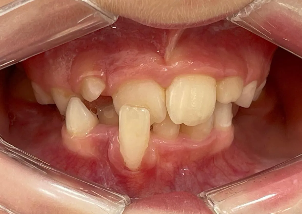 Dentes de uma criança antes do tratamento, muito apinhados e desencontrados, com um dente de baixo à frente dos de cima