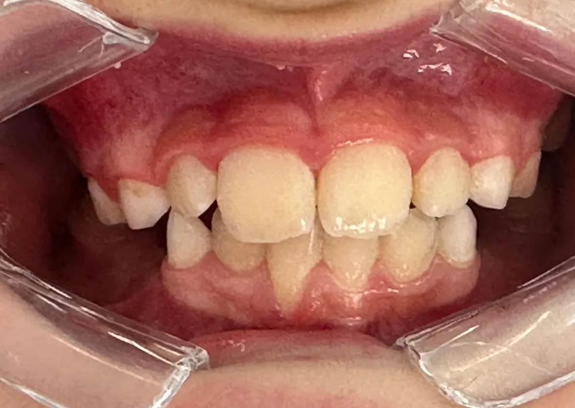 Os mesmos dentes depois do tratamento, alinhados e com os de cima a fechar à frente dos de baixo