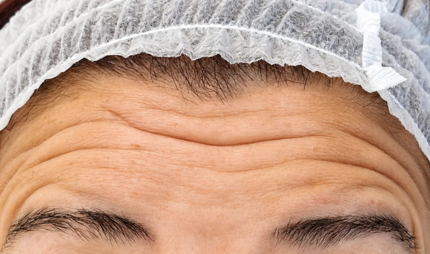 Testa antes da toxina botulínica, com rugas de expressão marcadas