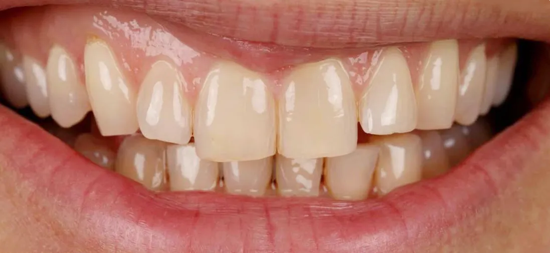 Sorriso antes do tratamento, com os dentes da frente desgastados, lascados e amarelados