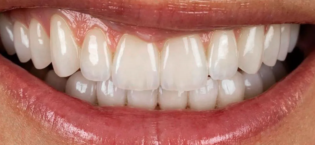 O mesmo sorriso depois do tratamento, com os dentes brancos, inteiros e uniformes