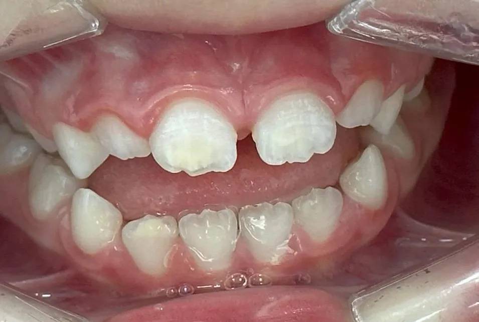 Dentes em mordida antes do tratamento, com os da frente sem se tocarem e um espaço aberto entre os de cima e os de baixo