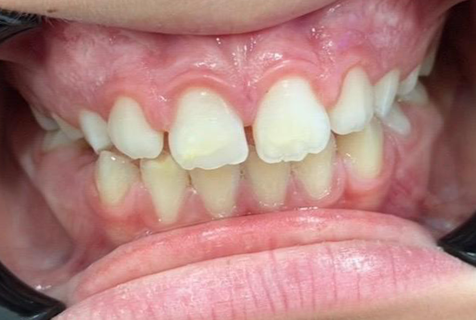 Os mesmos dentes depois do tratamento, com a mordida fechada e os dentes da frente a encaixar