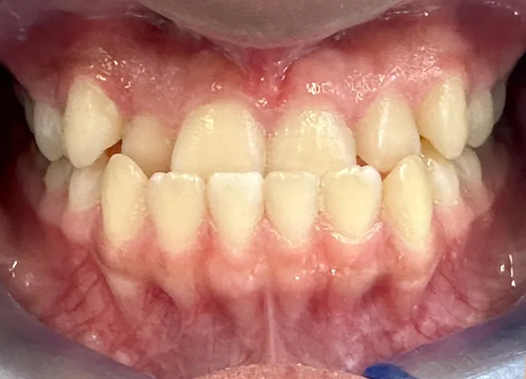 Dentes em mordida antes do tratamento, desalinhados e com dois dentes de cima por trás dos de baixo