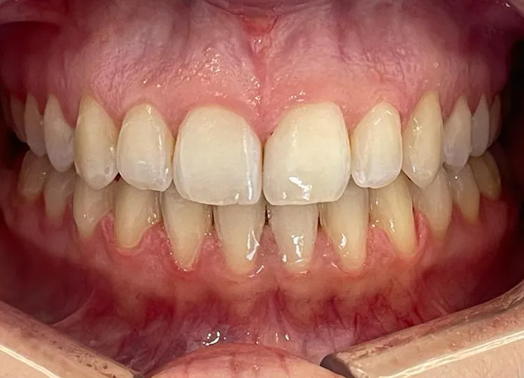 Os mesmos dentes depois do tratamento, alinhados e com os de cima a fechar à frente dos de baixo