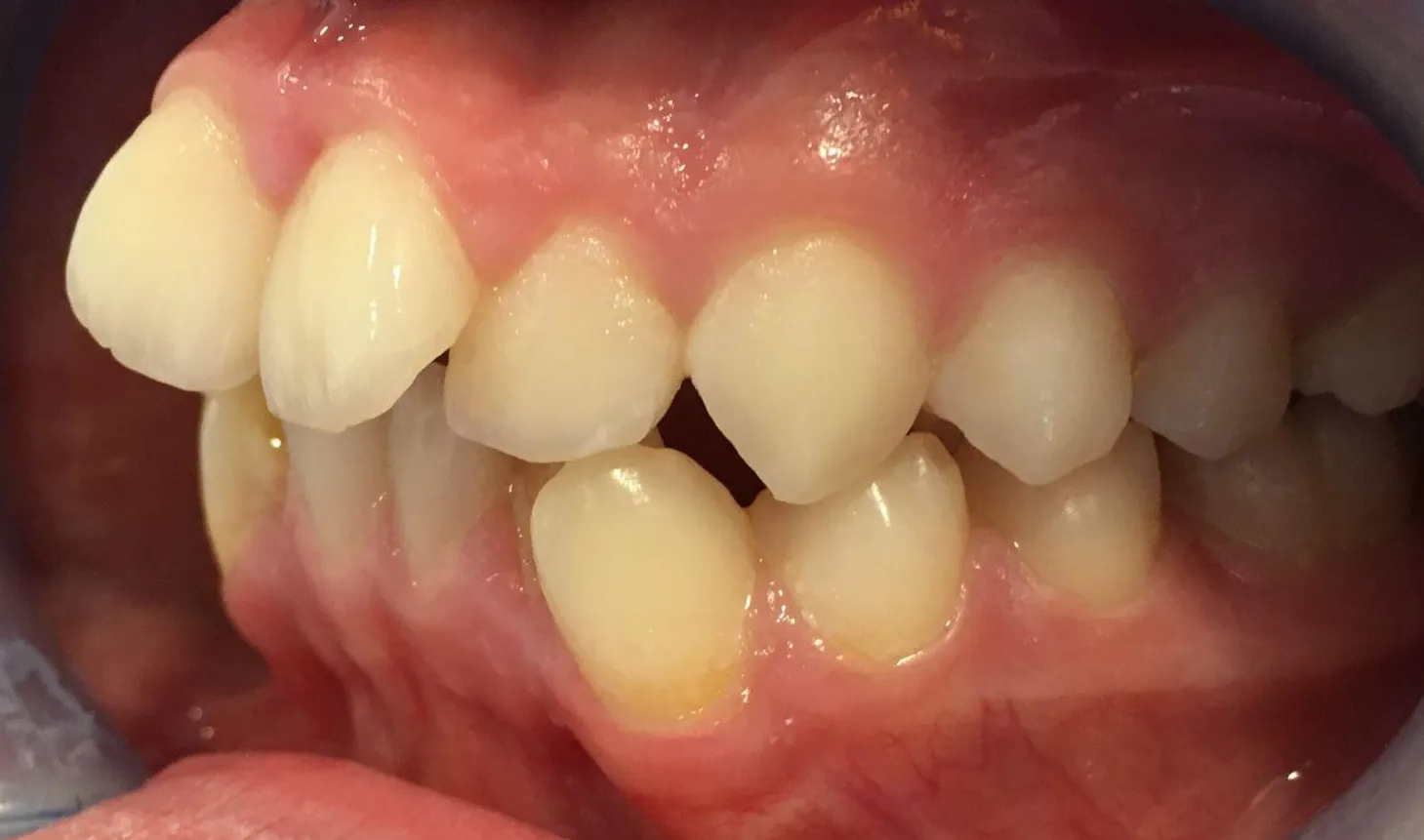 Vista de lado dos dentes antes do tratamento, desalinhados e com os de cima e os de baixo desencontrados