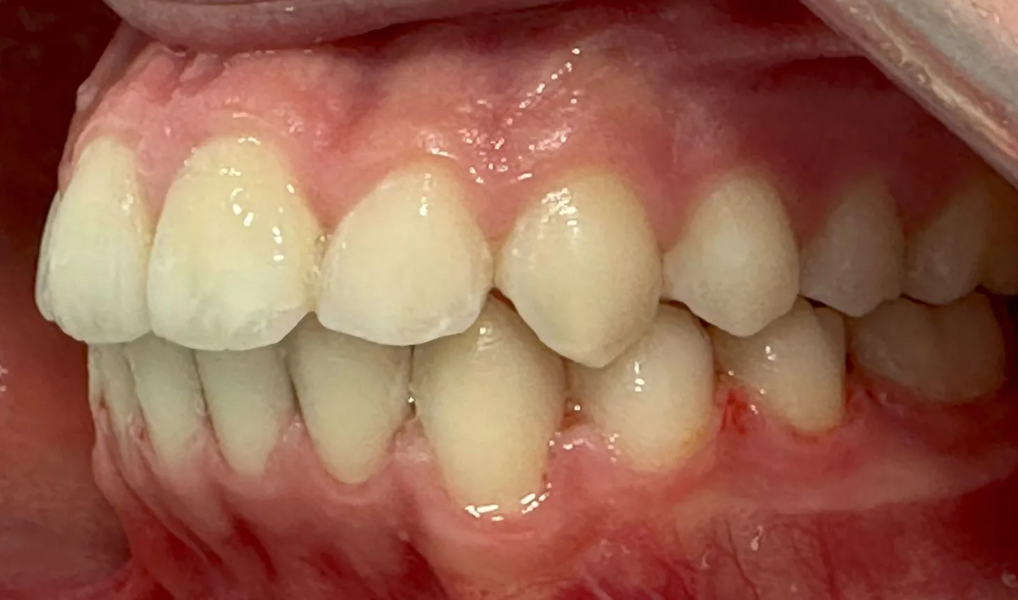 A mesma vista depois do tratamento, com os dentes alinhados e a encaixar uns nos outros