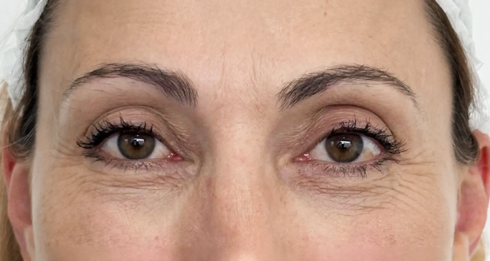 Contorno dos olhos antes dos polinucleotídeos, com rugas finas à volta e por baixo do olho