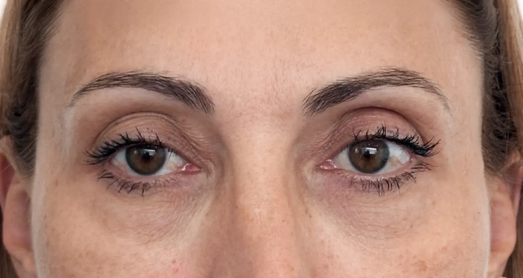 Contorno dos olhos depois dos polinucleotídeos, com as linhas de expressão suavizadas