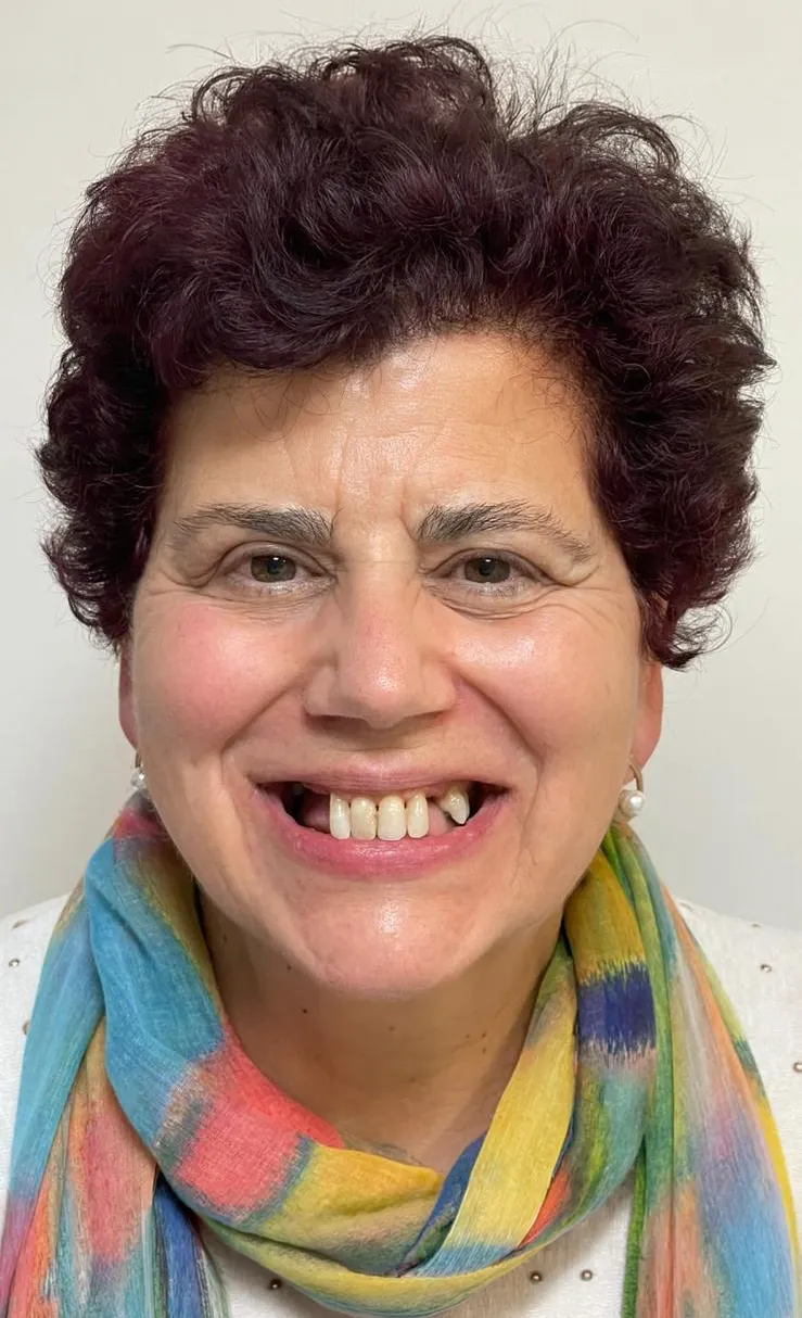 Mulher a sorrir antes do tratamento, com falhas de dentes dos dois lados da frente