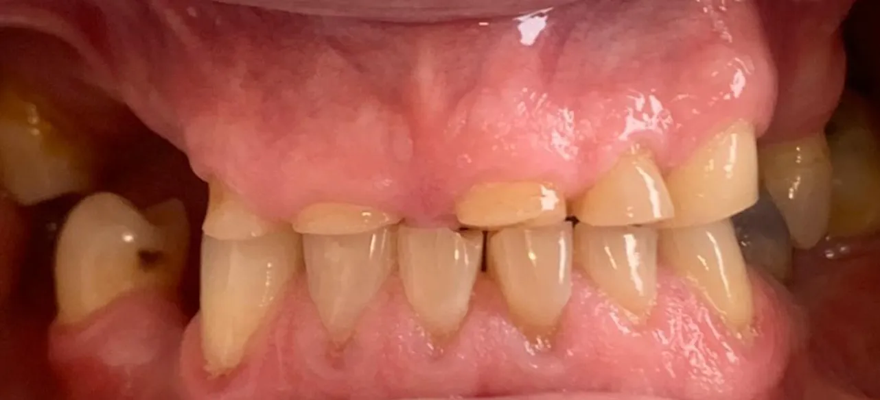 Dentes em mordida antes do tratamento, com os de cima curtos e desgastados e falhas nos dentes de trás