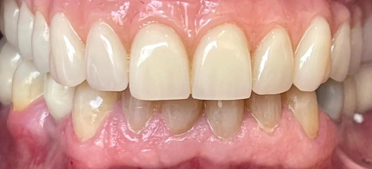 Os mesmos dentes depois do tratamento, com os de cima inteiros, brancos e alinhados