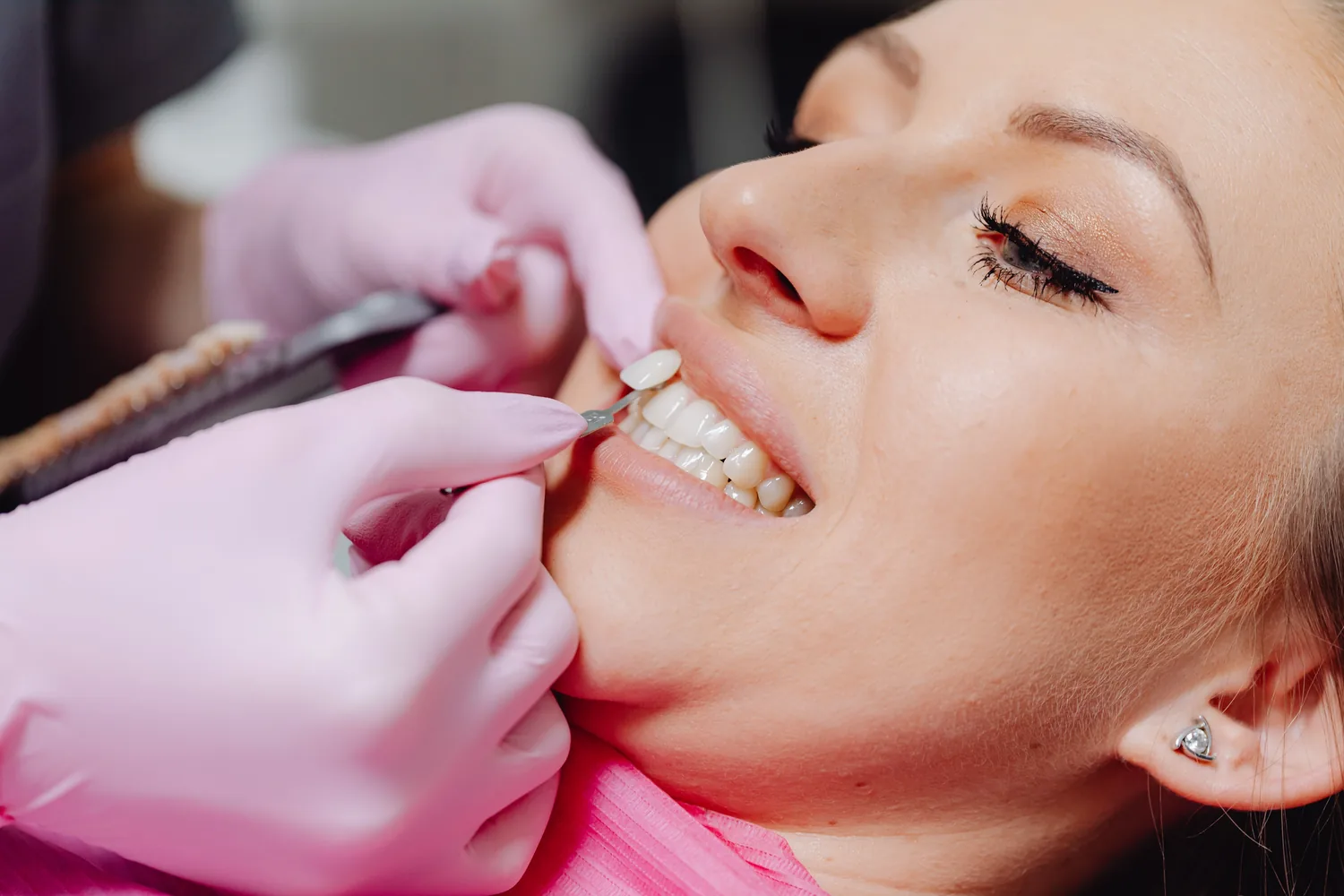 Dentista a colocar uma faceta dentária no dente de uma paciente