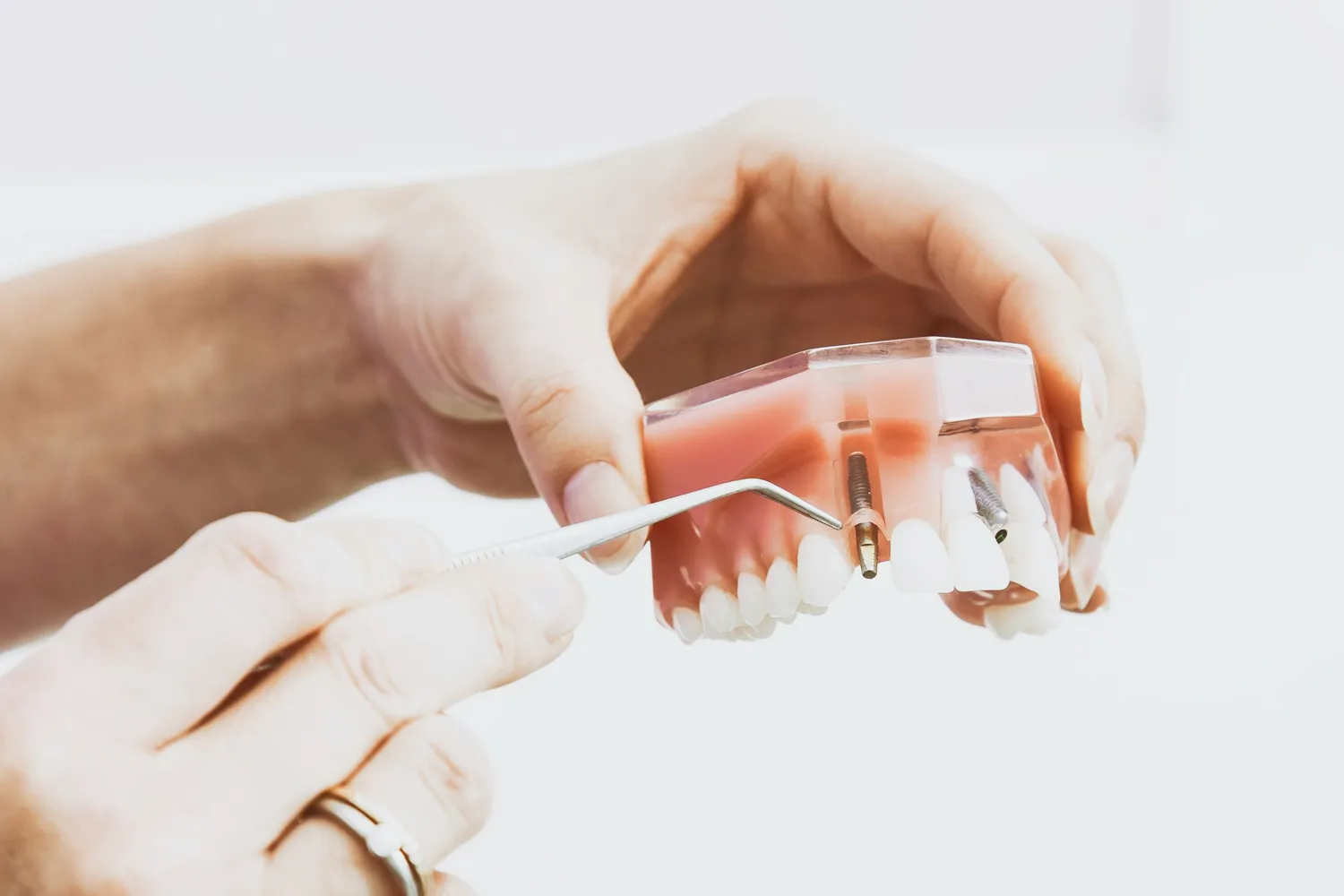 Modelo demonstrativo de uma arcada dentária com implantes