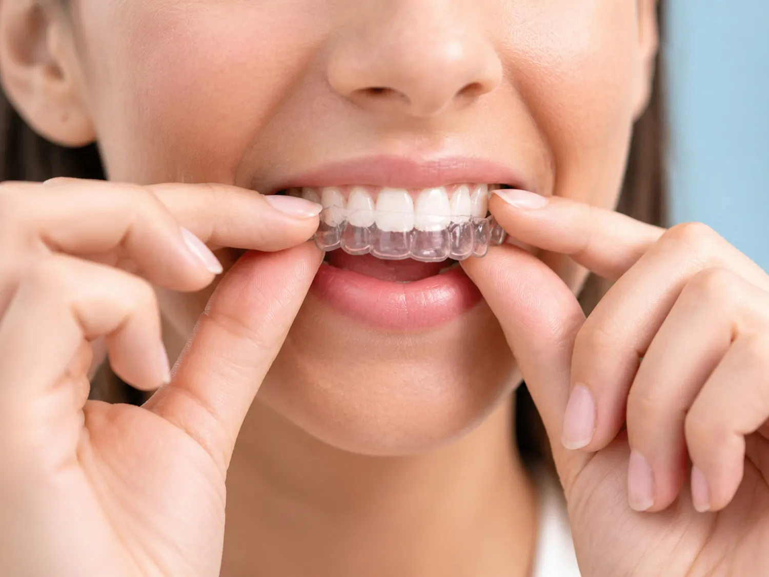 Doente a colocar um alinhador dentário transparente